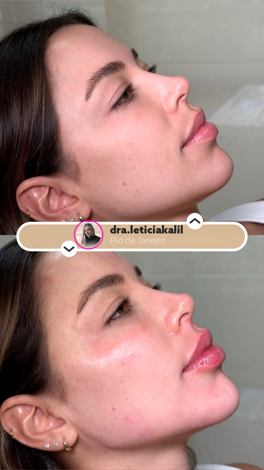 Antes e depois - Harmonização Facial