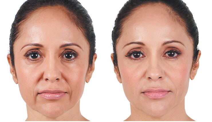 Preenchimento Facial